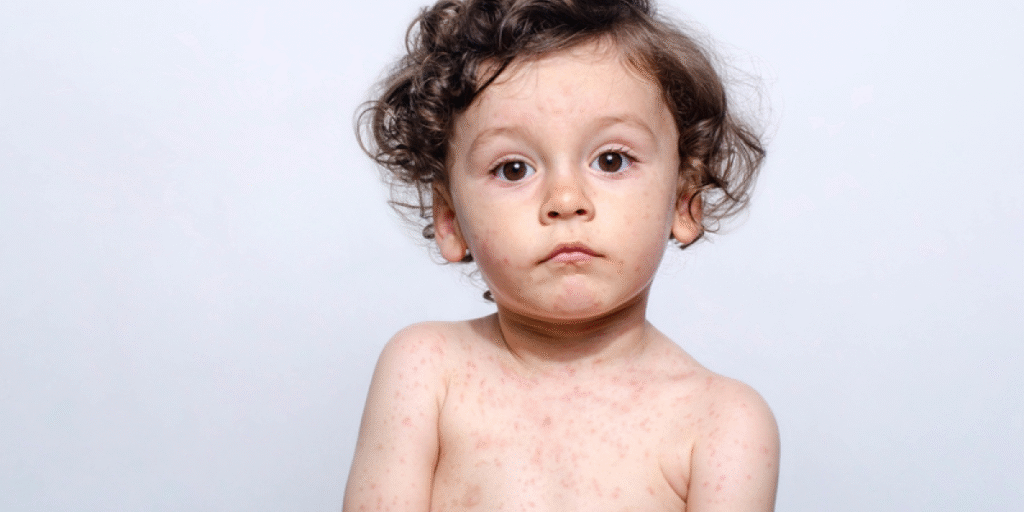 Measles outbreak in Pennsylvania showing symptoms, prevention, vaccination, and public health awareness information.